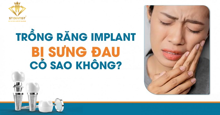 Trồng Răng Implant Bị Sưng Mặt Có Sao Không【Tìm Hiểu】