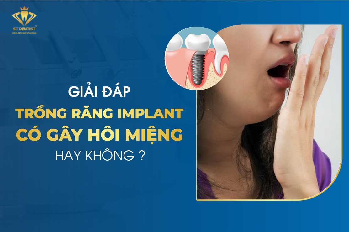 Trồng Răng Implant Có Bị Hôi Miệng Không【BS.Giải Đáp】