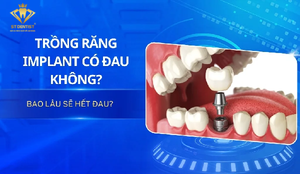 Trồng Răng Implant Có Đau Không【BS.Giải Đáp】