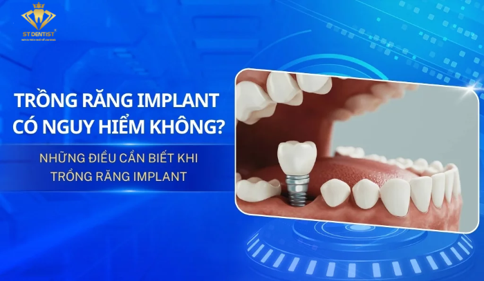 Trồng Răng Implant Có Nguy Hiểm Không【BS.Giải Đáp】