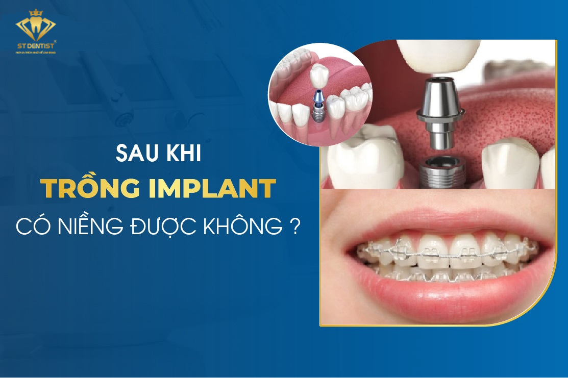 Trồng Răng Implant Có Niềng Răng Được Không【BS.Tư Vấn】