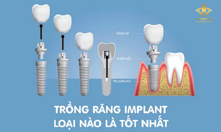 Trồng Răng Implant Loại Nào Tốt【BS.Giải Đáp】