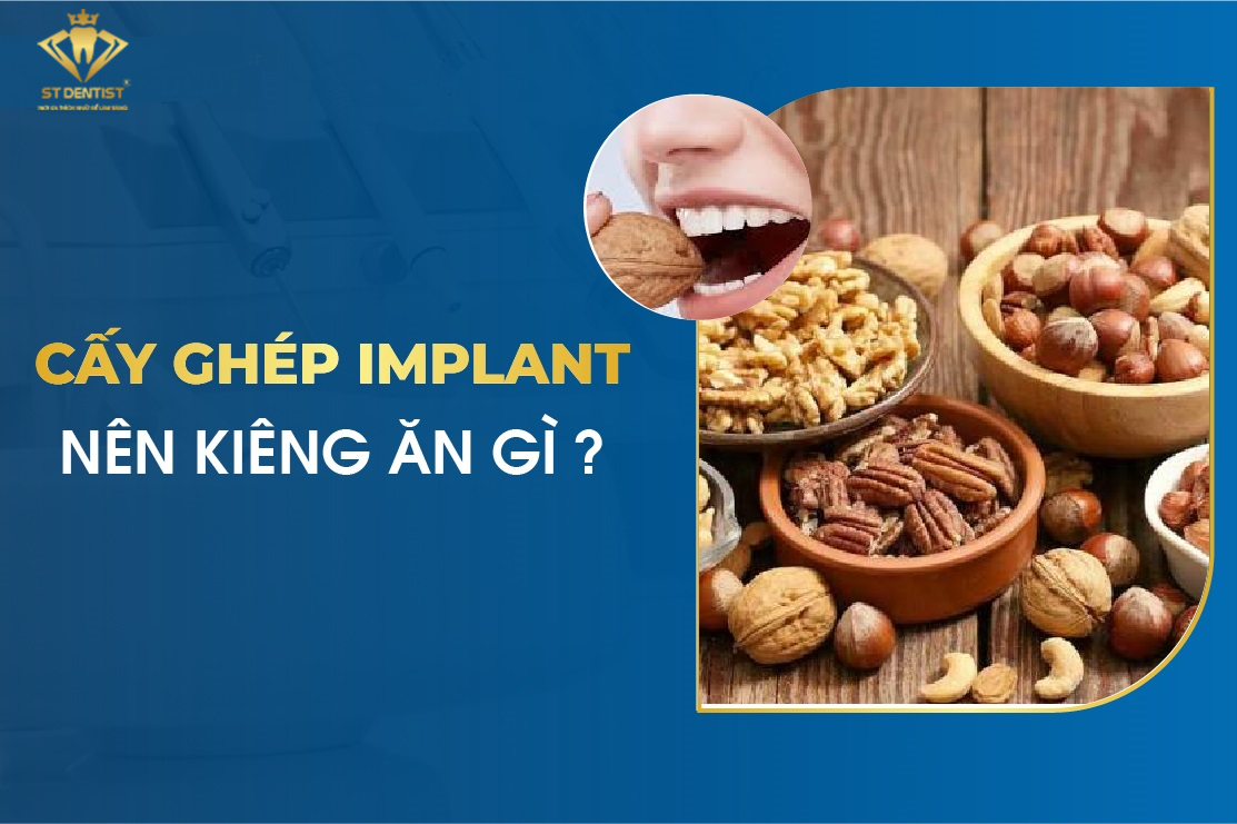 Trồng Răng Implant Nên Kiêng Ăn Gì【BS.Chia Sẻ】