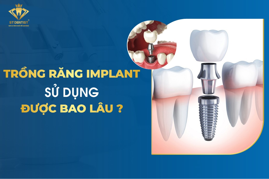 Trồng Răng Implant Sử Dụng Được Bao Lâu【BS.Giải Đáp】