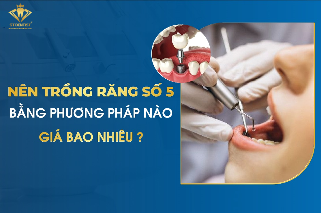 Trồng Răng Số 5 - Giải Pháp Phục Hình Răng Hiệu Quả An Toàn