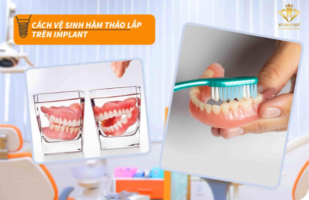 ve-sinh-ham-thao-lap-tren-implant