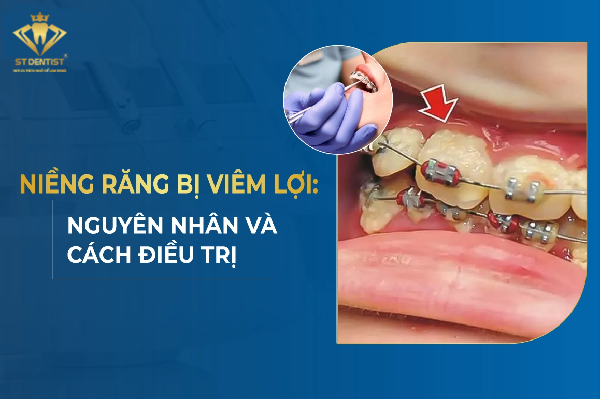 Viêm Lợi Khi Niềng Răng Do Đâu Và Cách Điều Trị Hiệu Quả