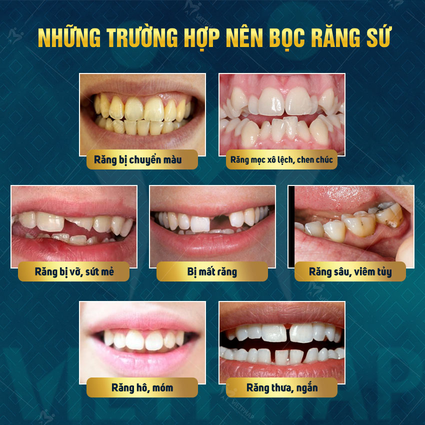 4. Nhược điểm của dán răng sứ