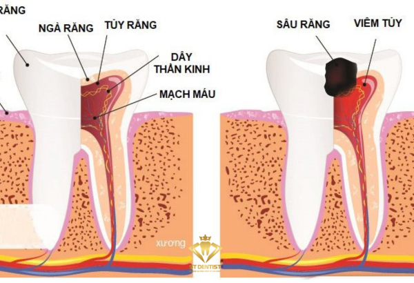 Điều trị tuỷ răng tại ST