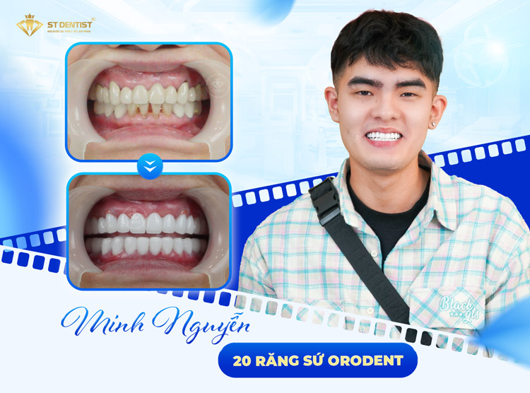 Hiệu quả trước và sau CỦA KHÁCH HÀNG
TẠI ST DENTIST