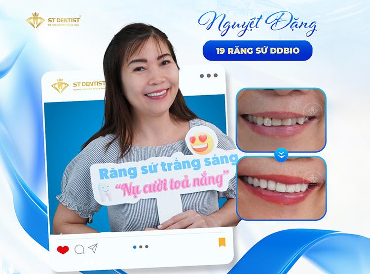 Hiệu quả trước và sau CỦA KHÁCH HÀNG
TẠI ST DENTIST