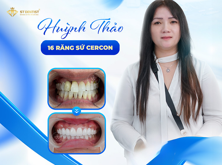 Hiệu quả trước và sau CỦA KHÁCH HÀNG
TẠI ST DENTIST