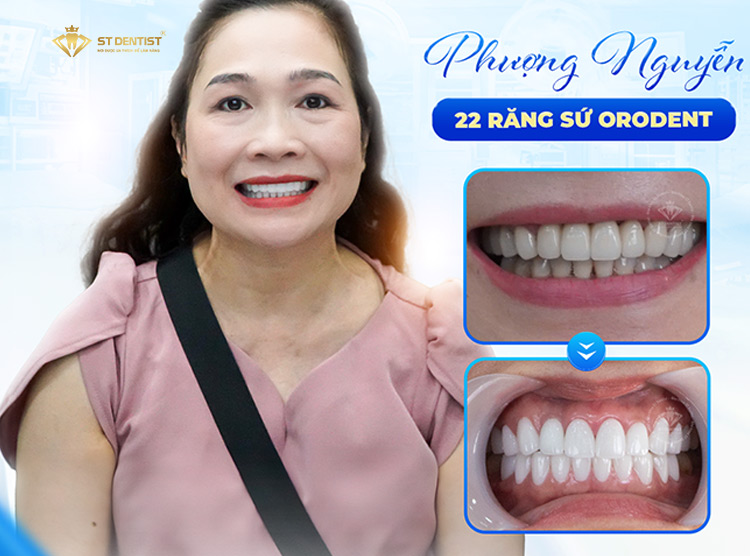 Hiệu quả trước và sau CỦA KHÁCH HÀNG
TẠI ST DENTIST