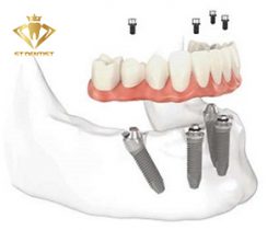 Kỹ thuật Implant All On – Phục hồi răng mất hiệu quả