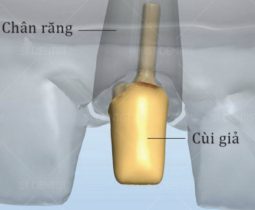 Tạo cùi giả sứ – Phục hồi thân răng