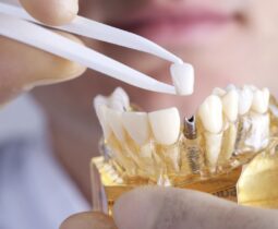Cấy ghép Implant là gì? Implant răng phù hợp với những ai?