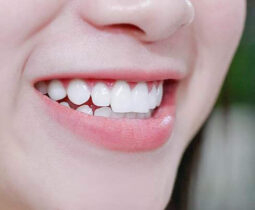 Bọc răng sứ bằng phương pháp nào để hiệu quả tốt nhất ?
