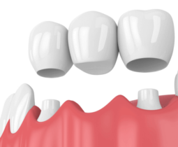 Bọc răng sứ như thế nào – Chuyên gia nha khoa ST Dentist tại thành phố Hồ Chí Minh chia sẻ