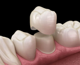 Có nên bọc răng sứ cho răng răng lộn xộn hay không – Các chuyên gia tại nha khoa ST Dentist chia sẻ.