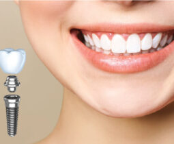 Cấy ghép răng implant mất bao nhiêu tiền? Vì sao nên cấy ghép răng implant ở nha khoa ST Dentist?