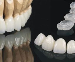 Những trường hợp nên dán phủ sứ răng