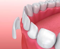 Dán răng sứ veneers – Khách hàng hỏi bác sĩ chuyên gia tại nha khoa ST Dentist trả lời