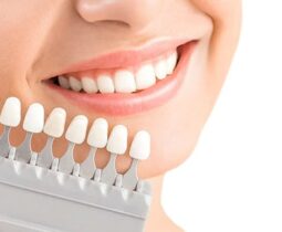 Những gì cần biết về mặt dán răng sứ thẩm mỹ