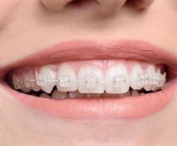 Giải đáp thắc mắc: Niềng răng có bao nhiêu loại?