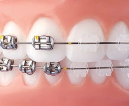 Niềng răng thẩm mỹ là gì? Có bao nhiêu phương pháp niềng răng thẩm mỹ được mọi người ưa chuộng?
