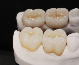 Răng sứ Titan có bị đen viền nướu không? Cách chăm sóc răng sứ Titan đúng cách như thế nào?