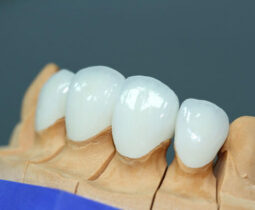 Thẻ bảo hành răng sứ – Các chính sách bạn cần biết khi bọc răng sứ tại nha khoa ST Dentist