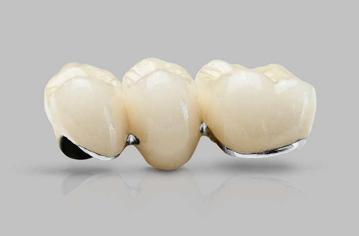 Răng sứ Ceramco là gì? Chất lượng và thẩm mỹ có bền đẹp không?