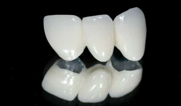 Răng sứ titan gồm loại nào | Răng sứ titan Vita Răng sứ Berlin và Margin