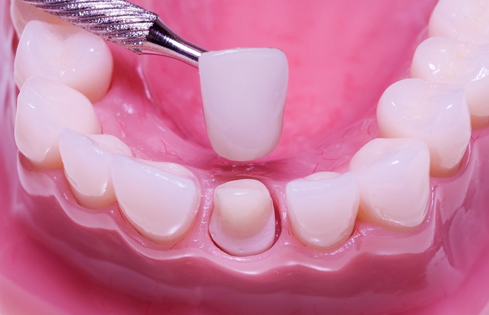 Răng sứ kim loại tốt không ?